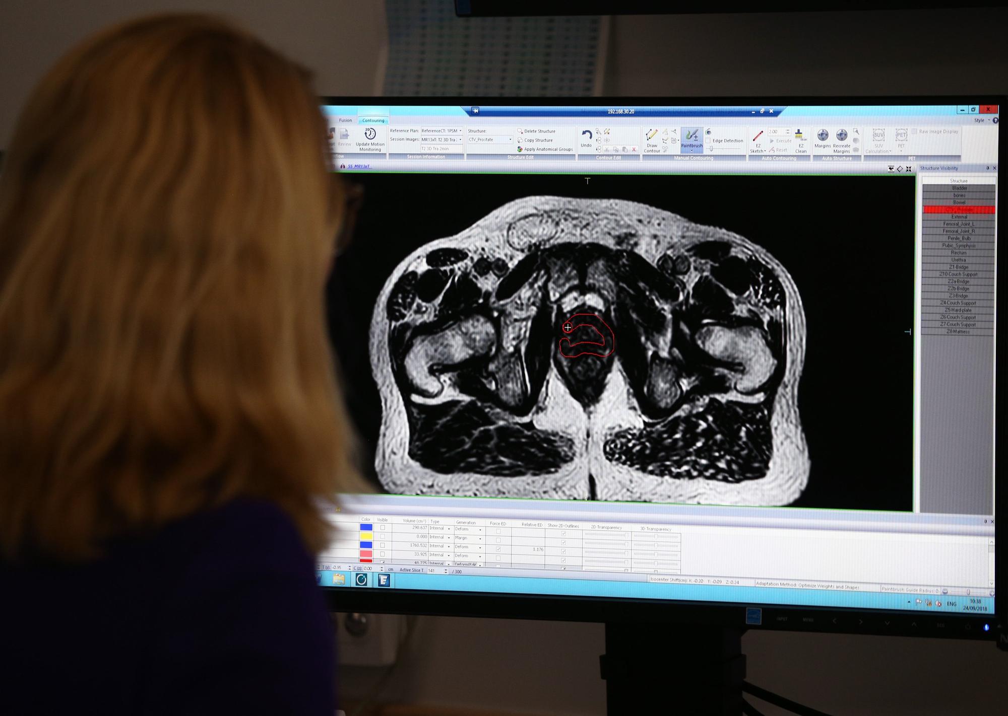 Scientists harness healthy gut bacteria to fight prostate cancer